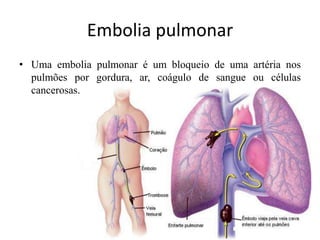Embolia pulmonar
• Uma embolia pulmonar é um bloqueio de uma artéria nos
pulmões por gordura, ar, coágulo de sangue ou células
cancerosas.
 