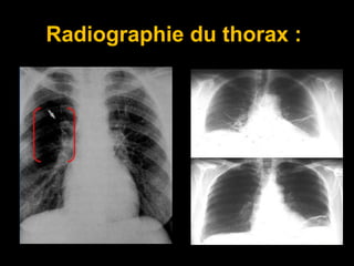Radiographie du thorax :
 