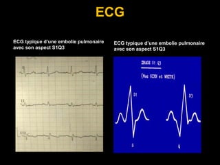 ECG
ECG typique d’une embolie pulmonaire
avec son aspect S1Q3
ECG typique d’une embolie pulmonaire
avec son aspect S1Q3
 