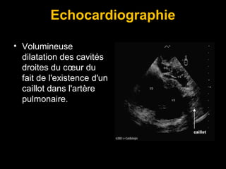 Echocardiographie
• Volumineuse
dilatation des cavités
droites du cœur du
fait de l'existence d'un
caillot dans l'artère
pulmonaire.
 