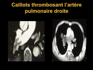 Caillots thrombosant l’artère
pulmonaire droite
 