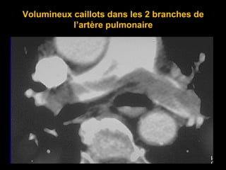Volumineux caillots dans les 2 branches de
l’artère pulmonaire
 
