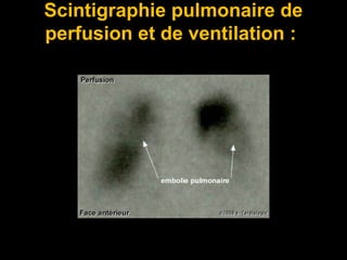 Scintigraphie pulmonaire de
perfusion et de ventilation :
 
