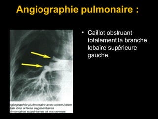 Angiographie pulmonaire :
• Caillot obstruant
totalement la branche
lobaire supérieure
gauche.
 