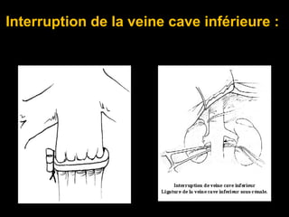 Interruption de la veine cave inférieure :
 