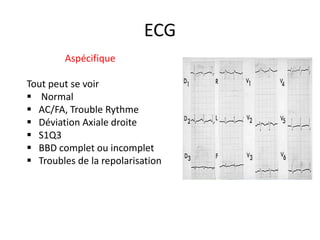 ECG
Aspécifique
Tout peut se voir
 Normal
 AC/FA, Trouble Rythme
 Déviation Axiale droite
 S1Q3
 BBD complet ou incomplet
 Troubles de la repolarisation
 