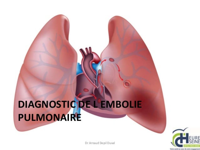 Embolie pulmonaire aux urgences esc 2013