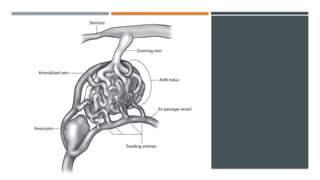 Embolisasi All About of EMBOLISASI Artery Venous Malformation.pptx