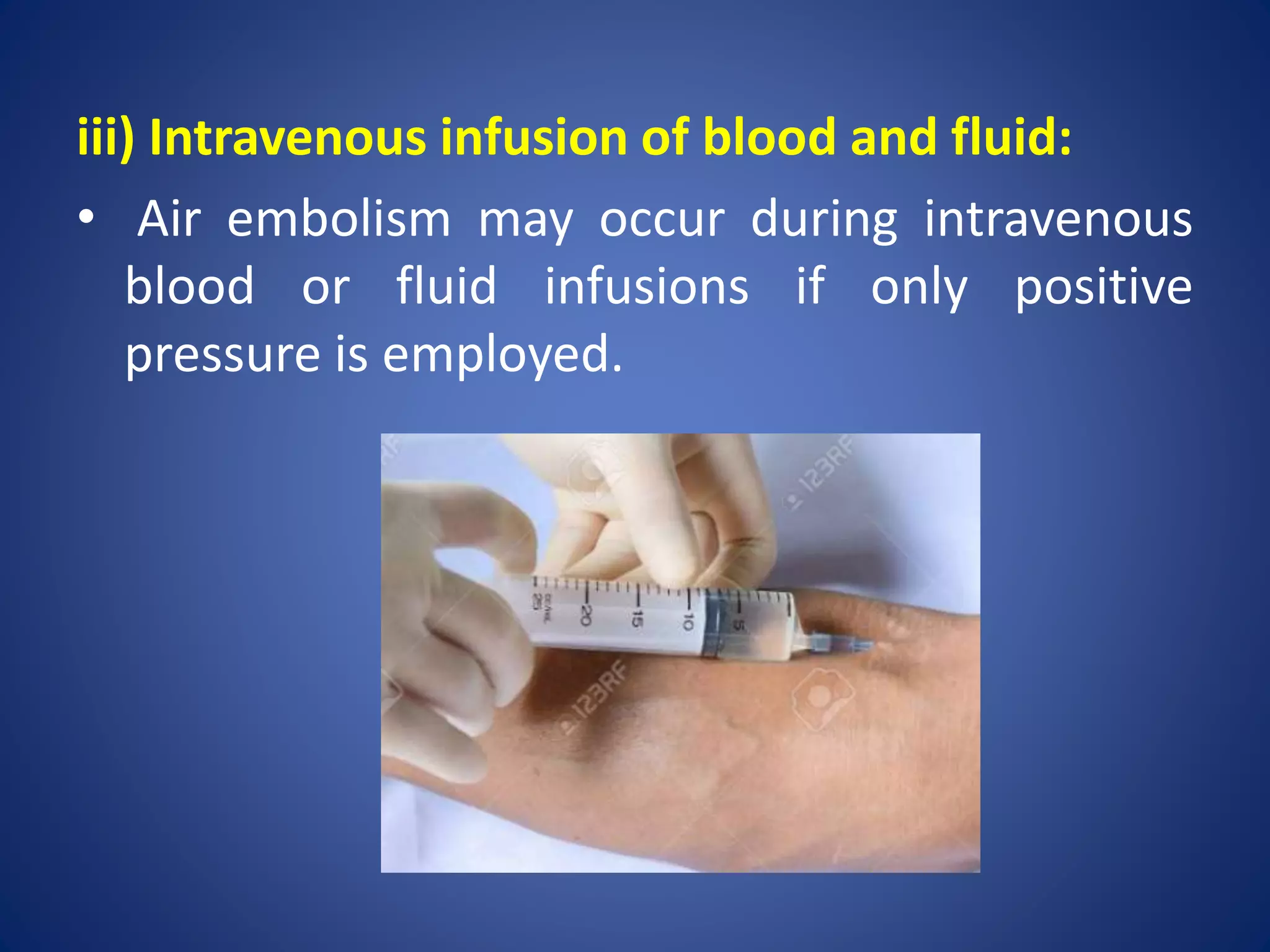 Embolism | PPSX