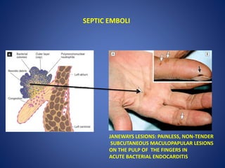 SEPTIC EMBOLI
JANEWAYS LESIONS: PAINLESS, NON-TENDER
SUBCUTANEOUS MACULOPAPULAR LESIONS
ON THE PULP OF THE FINGERS IN
ACUTE BACTERIAL ENDOCARDITIS
 