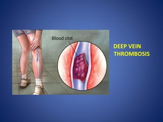 DEEP VEIN
THROMBOSIS
 