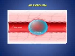 AIR EMBOLISM
 