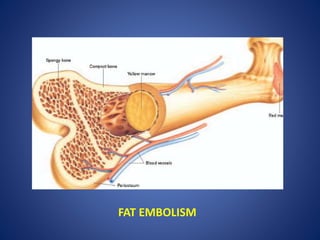 FAT EMBOLISM
 