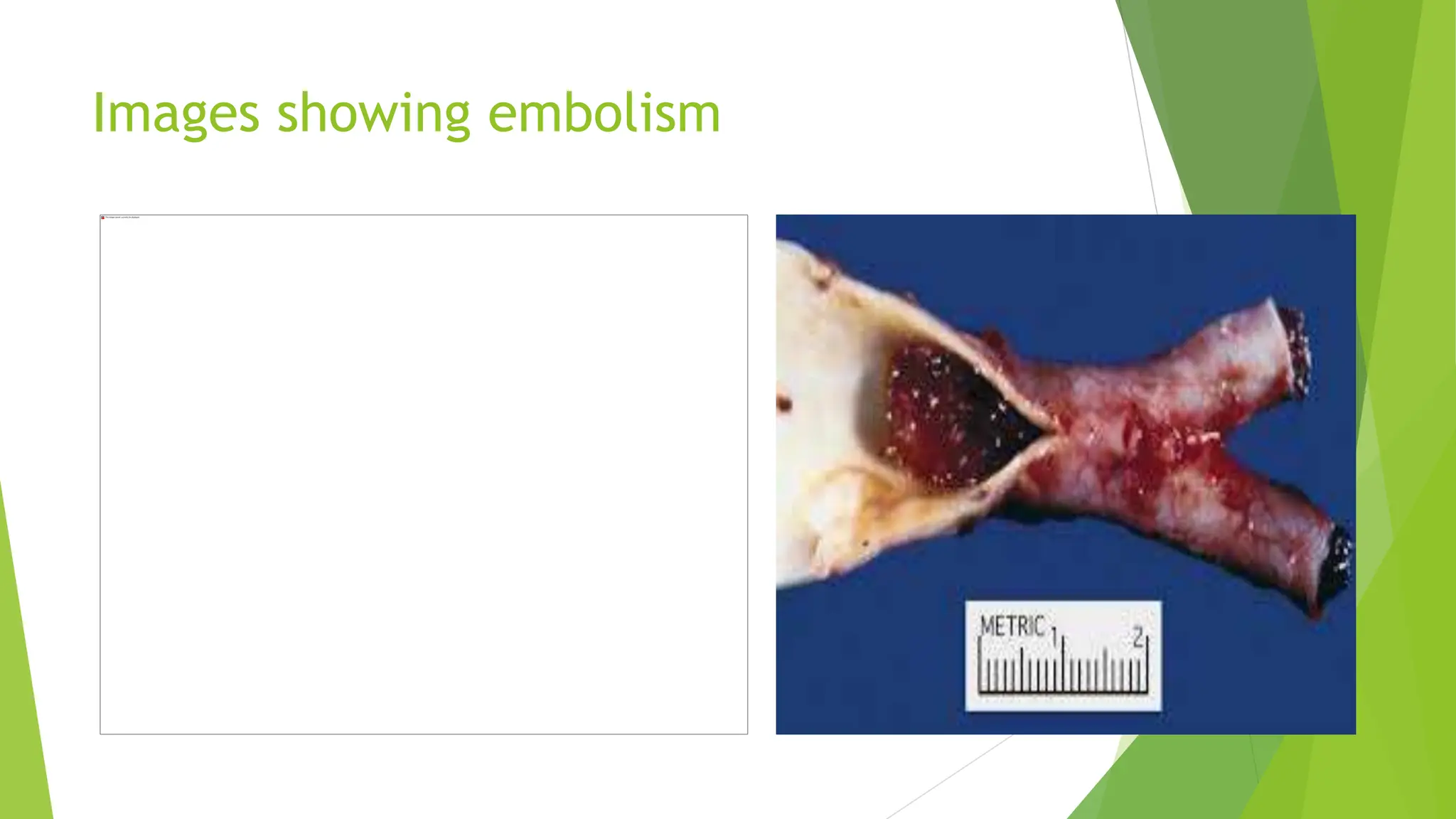 Images showing embolism
 