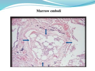 EMBOLISM - definition and classification | PPTX