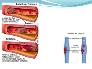 EMBOLISM - definition and classification | PPTX