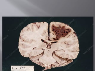 EMBOLISM BY ASAD ULLAH.pptx..............