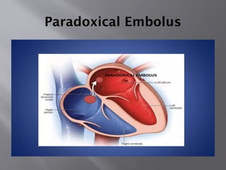 Paradoxical Embolus
 