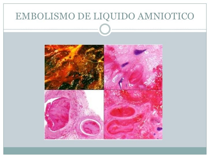 Embolismo en el embarazo