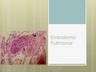 Embolismo
Pulmonar
 