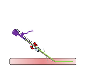 EMBOLIZATION Techniques and classifications | PPTX