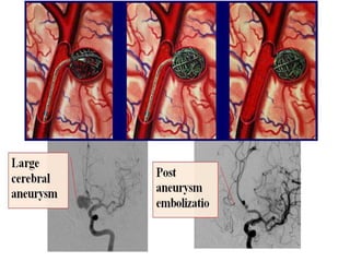 EMBOLIZATION Techniques and classifications | PPTX