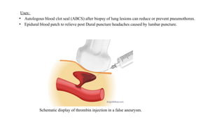 embolizing agent( Interventional Radiology).pptx