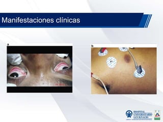 Manifestaciones clínicas
 