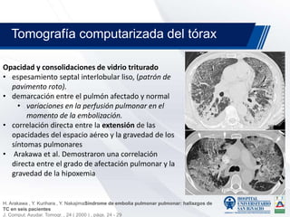 Opacidad y consolidaciones de vidrio triturado
• espesamiento septal interlobular liso, (patrón de
pavimento roto).
• demarcación entre el pulmón afectado y normal
• variaciones en la perfusión pulmonar en el
momento de la embolización.
• correlación directa entre la extensión de las
opacidades del espacio aéreo y la gravedad de los
síntomas pulmonares
• Arakawa et al. Demostraron una correlación
directa entre el grado de afectación pulmonar y la
gravedad de la hipoxemia
Tomografía computarizada del tórax
H. Arakawa , Y. Kurihara , Y. NakajimaSíndrome de embolia pulmonar pulmonar: hallazgos de
TC en seis pacientes
J. Comput. Ayudar. Tomogr. , 24 ( 2000 ) , págs. 24 - 29
 