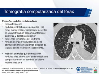 Pequeños nódulos centrilobulares
• menos frecuente
• nódulos centrilobulares pequeños (<10
mm), mal definidos, típicamente descritos
en una distribución predominantemente
periférica y del lóbulo superior
• fases más tempranas del síndrome
• reflejan el origen vasculogénico de la
obstrucción mecánica por los glóbulos de
la grasa con la resolución subsecuente.
• modelos animales que demostraron
nódulos a las 2 h después de la embolia en
comparación con los cambios de vidrio
molido a las 24 h
.
K. Malagari , N. Economopoulos , C. Stoupis , Z. Daniil , S. Papiris , NL Muller , D. KelekisHallazgos de TC de
alta resolución en la embolia de grasa pulmonar leve
Pecho , 123 ( 2003 ) , págs. 1196 - 1201
Tomografía computarizada del tórax
 