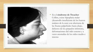 • En el síndrome de Treacher
Collins, existe hipoplasia malar
(desarrollo insuficiente de los huesos
malares de la cara) con aberturas de
las fisuras palpebrales hacia abajo,
defectos de los párpados inferiores,
deformaciones del oído externo y a
veces anomalías de los oídos medio e
interno
 