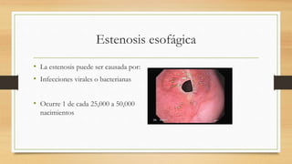 Estenosis esofágica
• La estenosis puede ser causada por:
• Infecciones virales o bacterianas
• Ocurre 1 de cada 25,000 a 50,000
nacimientos
 