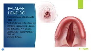 • A veces acompaña a labio hendido.
• 1-2500. +M.
• Puede afectar solo úvula: cola de pez.
• Extenderse a paladar duro o blando.
• Falta de fusión de Pr Pl laterales.
• Labio fisurado + paladar hendido=
Fisura Lap
• Síndrome de Patau.
 