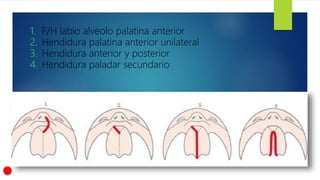 1. F/H labio alveolo palatina anterior
2. Hendidura palatina anterior unilateral
3. Hendidura anterior y posterior
4. Hendidura paladar secundario
 