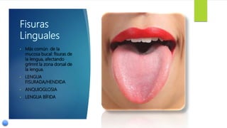 • Más común de la
mucosa bucal: fisuras de
la lengua, afectando
grlmnt la zona dorsal de
la lengua.
• LENGUA
FISURADA/HENDIDA
• ANQUIOGLOSIA
• LENGUA BÍFIDA
 