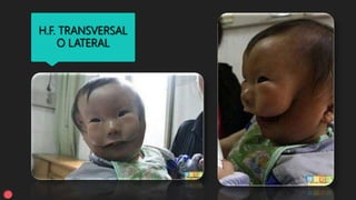 H.F. TRANSVERSAL
O LATERAL
 