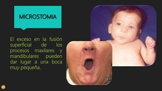 MICROSTOMIA
 