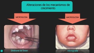 Alteraciones de los mecanismos de
crecimiento
MICROGLOSIA MACROGLOSIA
 