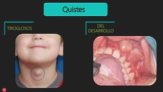 Quistes
 