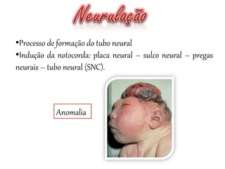 •Processo de formação do tubo neural
•Indução da notocorda: placa neural – sulco neural – pregas
neurais – tubo neural (SNC).
Anomalia
 
