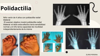 Polidactilia
ELIRIS PEREIRA
Niño varón de 4 años con polidactilia radial
bilateral
El examen objetivo mostró polidactilia radial
bilateral: el dedo extra-efectivo tenía sensibilidad
normal y el niño tenía capacidad de movilidad
independientemente de la misma
 