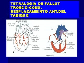 TET RALOG IA DE FALLOT
TRONC O-CONO ,
DESP LAZAMIE NT O ANT.D EL
TABIQU E
 