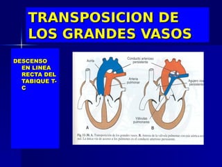 TRANSPOSICION DE
    LOS GRANDES VASOS
DESCENSO
  EN LINEA
  RECTA DEL
  TABIQUE T-
  C
 