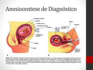 Amniocentese de Diagnóstico
 