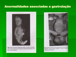 Anormalidades associadas a gastrulação
 