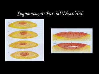 Segmentação Parcial Discoidal
 