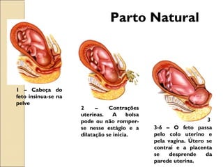 1 – Cabeça do
feto insinua-se na
pelve
2 – Contrações
uterinas. A bolsa
pode ou não romper-
se nesse estágio e a
dilatação se inicia.
3-6 – O feto passa
pelo colo uterino e
pela vagina. Útero se
contrai e a placenta
se desprende da
parede uterina.
Parto Natural
3
 