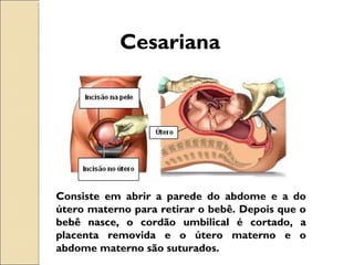 Cesariana
Consiste em abrir a parede do abdome e a do
útero materno para retirar o bebê. Depois que o
bebê nasce, o cordão umbilical é cortado, a
placenta removida e o útero materno e o
abdome materno são suturados.
 