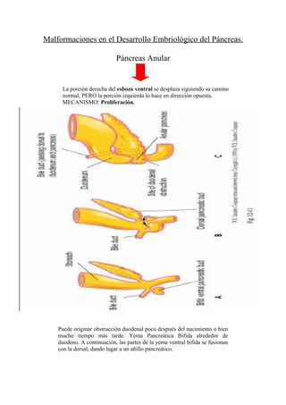 Malformaciones en el Desarrollo Embriológico del Páncreas.

                            Páncreas Anular


     La porción derecha del esbozo ventral se desplaza siguiendo su camino
     normal, PERO la porción izquierda lo hace en dirección opuesta.
     MECANISMO: Proliferación.




    Puede originar obstrucción duodenal poco después del nacimiento o bien
    mucho tiempo más tarde. Yema Pancreática Bifida alrededor de
    duodeno. A continuación, las partes de la yema ventral bifida se fusionan
    con la dorsal, dando lugar a un añillo pancreático.
 