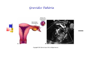 Gravidez TubáriaGravidez TubáriaGravidez TubáriaGravidez TubáriaGravidez TubáriaGravidez TubáriaGravidez TubáriaGravidez Tubária
 